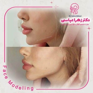 تزریق-فیلر-3