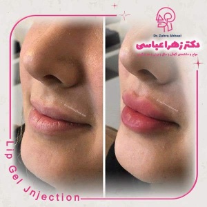 تزریق-فیلر-4