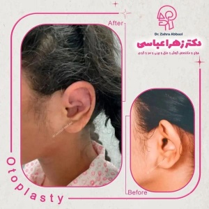 جراحی-گوش-در-تهران-1