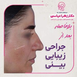 جراحی-بینی-در-تهران-27