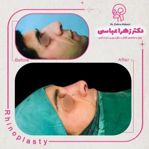جراحی-بینی-در-تهران-28