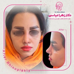 جراحی-بینی-در-تهران14