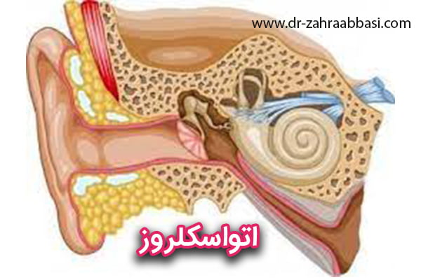 اتواسکلروز - دکتر زهرا عباسی
