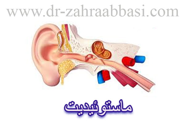 ماستوئیدیت - دکتر زهرا عباسی