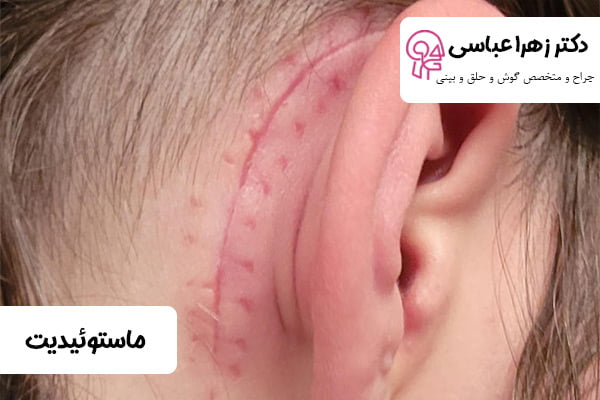 درمان ماستوئیدیت - دکتر عباسی