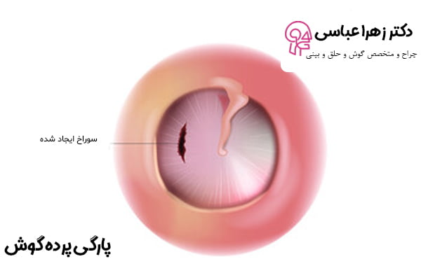 پارگی پرده گوش - دکتر عباسی