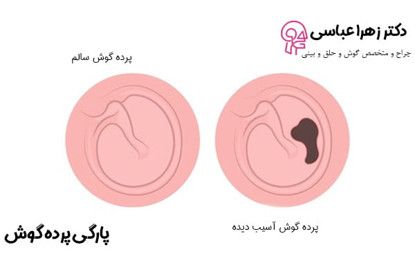 پارگی پرده گوش - دکتر عباسی