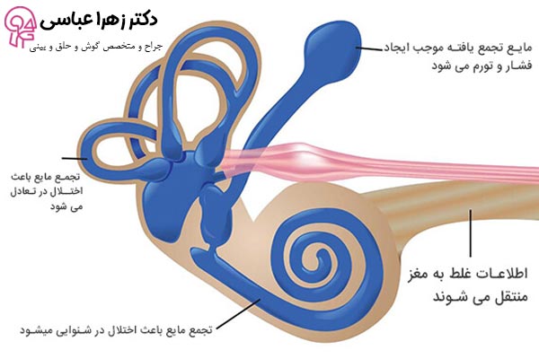 بیماری منییر - دکتر زهرا عباسی