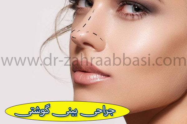 جراحی بینی گوشتی + دکتر زهرا عباسی
