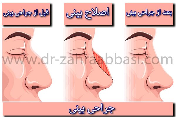 جراحی بینی در تهران + دکتر زهرا عباسی