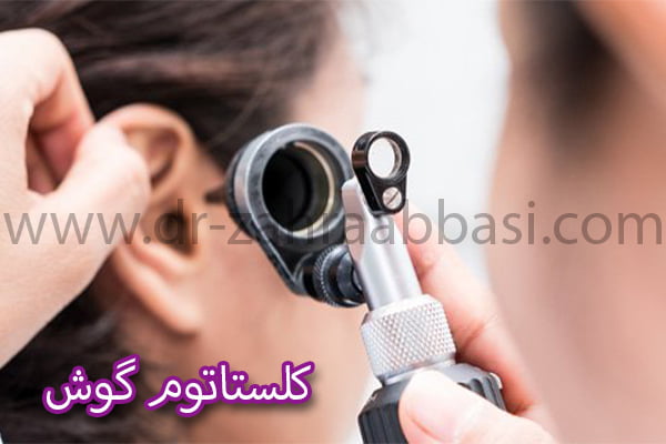 کلستاتوم گوش - دکتر زهرا عباسی