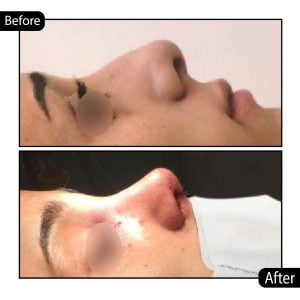 جراحی بینی - دکتر عباسی