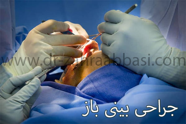 جراحی بینی باز - دکتر زهرا عباسی