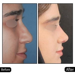 جراحی بینی - دکتر عباسی