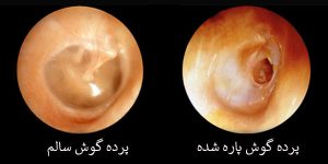عکس پرده گوش پاره و سالم _ دکتر زهرا عباسی