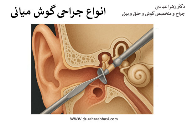انواع جراحی گوش میانی