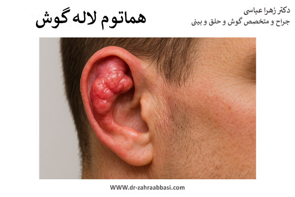 هماتوم لاله گوش 