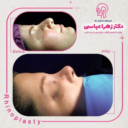 جراحی بینی در تهران - دکتر عباسی